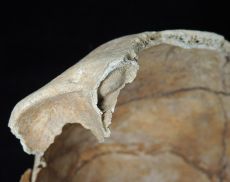 Particolate della lesione ovalare nel seno frontale destro (Foto da Unipi News)